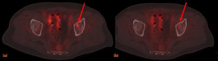 Εικόνα 2 Η απεικόνιση με 18F- PSMA PET-CT