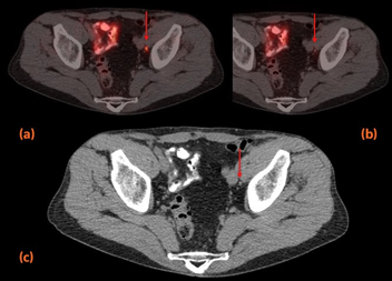 απεικόνιση με 18F-PSMA PET-CT abc