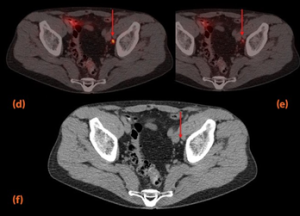απεικόνιση με 18F-PSMA PET-CT def