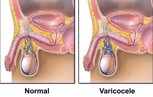 Κιρσοκήλη (Varicocele)